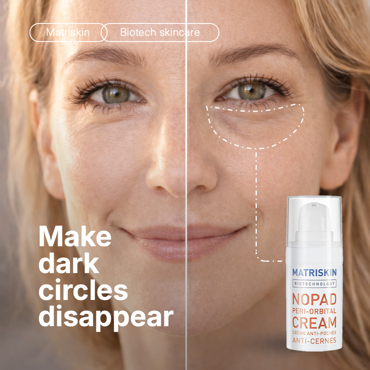 Matriskin NoPad Peri-Orbital Eye Cream for periorbital puffiness, periorbital puffiness causes, edema under eyes, under-eye edema, fluid retention under eyes, fluid around eyes, microcirculation under eyes, puffiness, eye bags and dark circles.