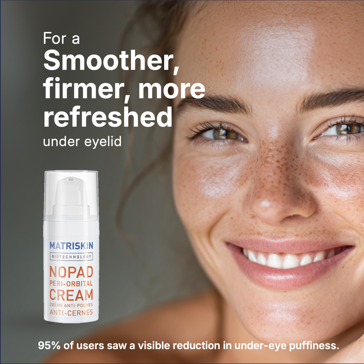 Matriskin NoPad Peri-Orbital Eye Cream for periorbital puffiness, periorbital puffiness causes, edema under eyes, under-eye edema, fluid retention under eyes, fluid around eyes, microcirculation under eyes, puffiness, eye bags and dark circles.
