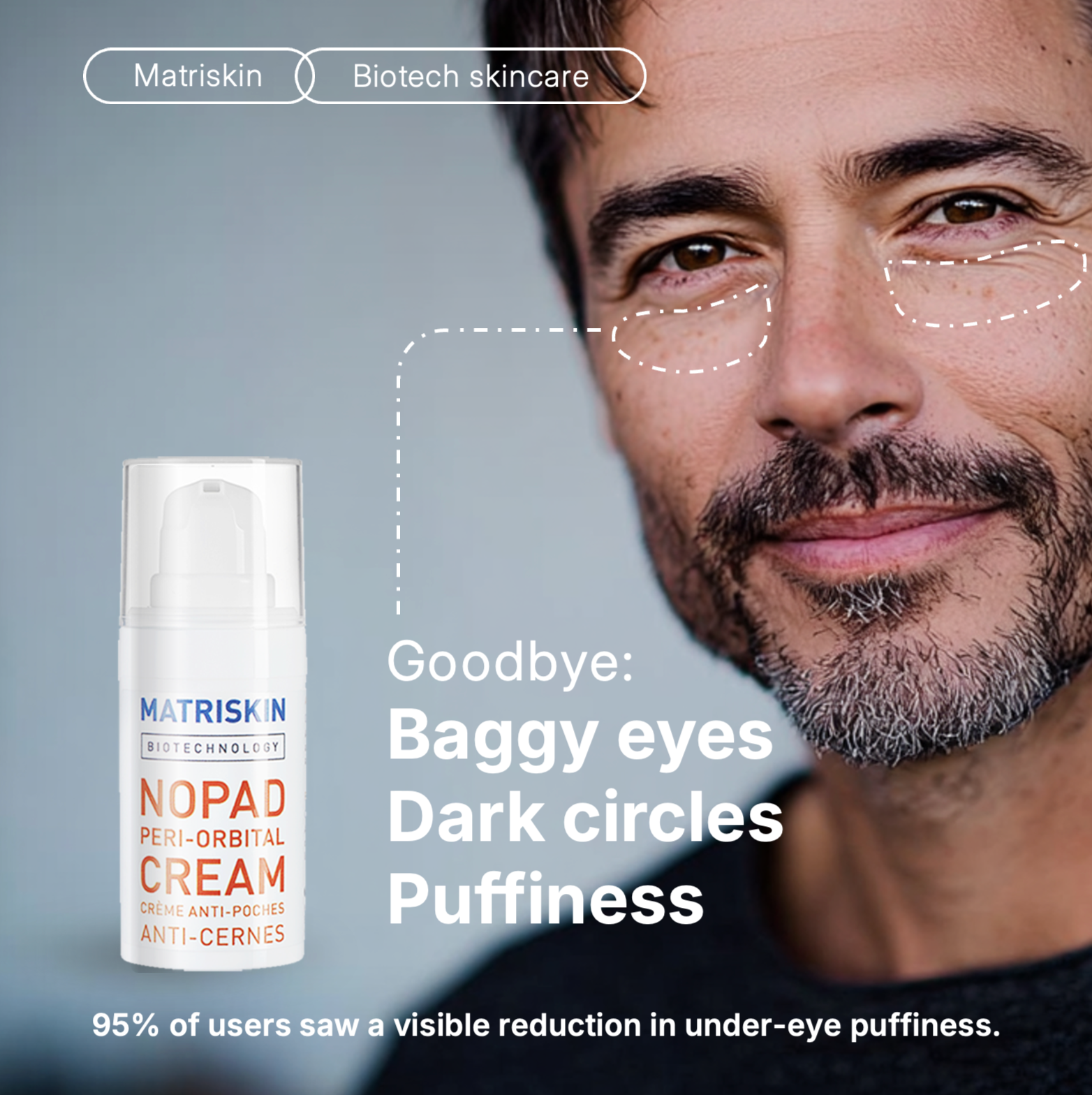 Matriskin NoPad Peri-Orbital Eye Cream for periorbital puffiness, periorbital puffiness causes, edema under eyes, under-eye edema, fluid retention under eyes, fluid around eyes, microcirculation under eyes, puffiness, eye bags and dark circles.